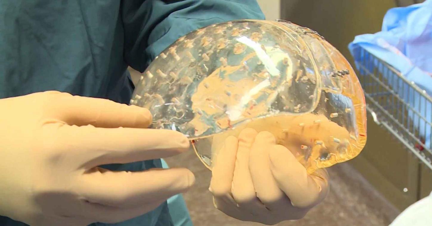 Eerste volledige 3D-geprinte schedel