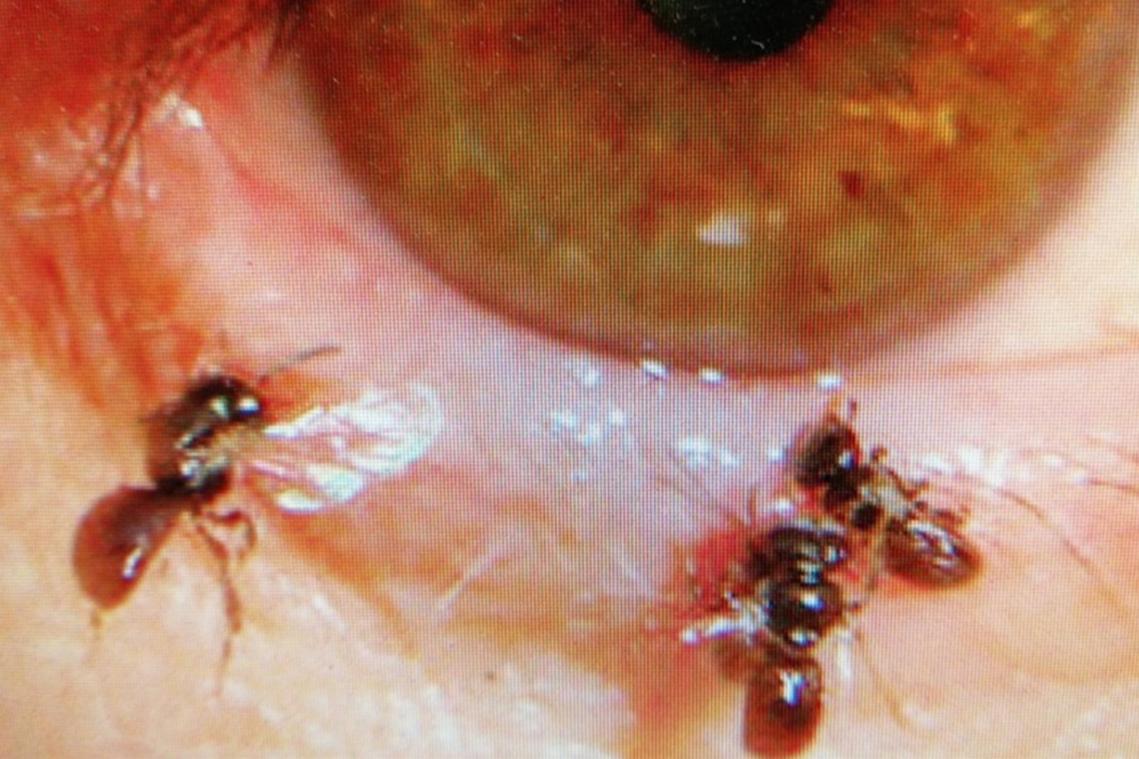 Dokter vindt vier levende bijen in oog Taiwanese vrouw