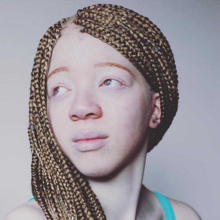 Tienermodel met albinisme verschijnt in Italiaanse Vogue