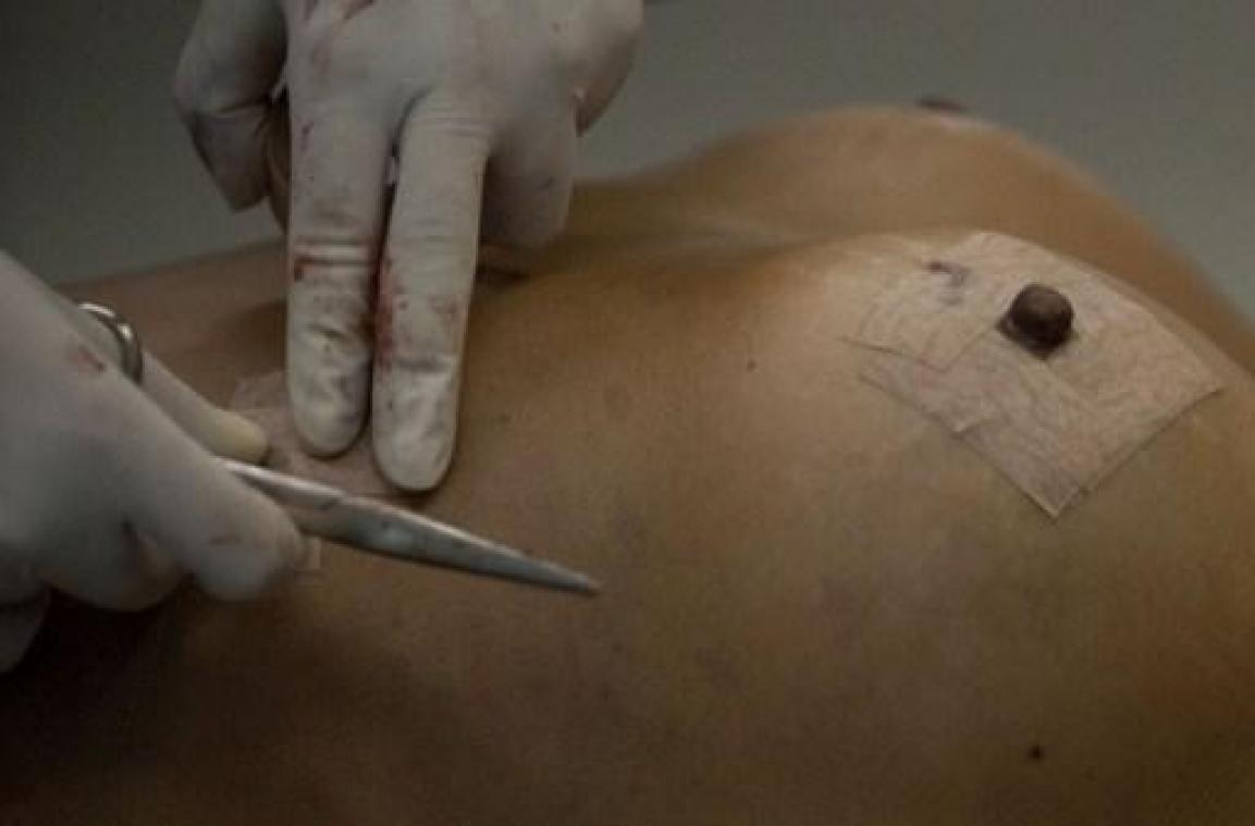 Centraal register implantaten op komst