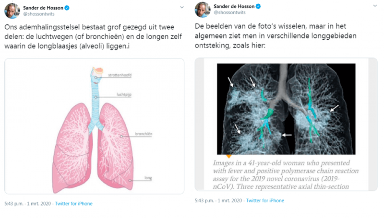 Longarts toont aan wat het coronavirus met je longen doet