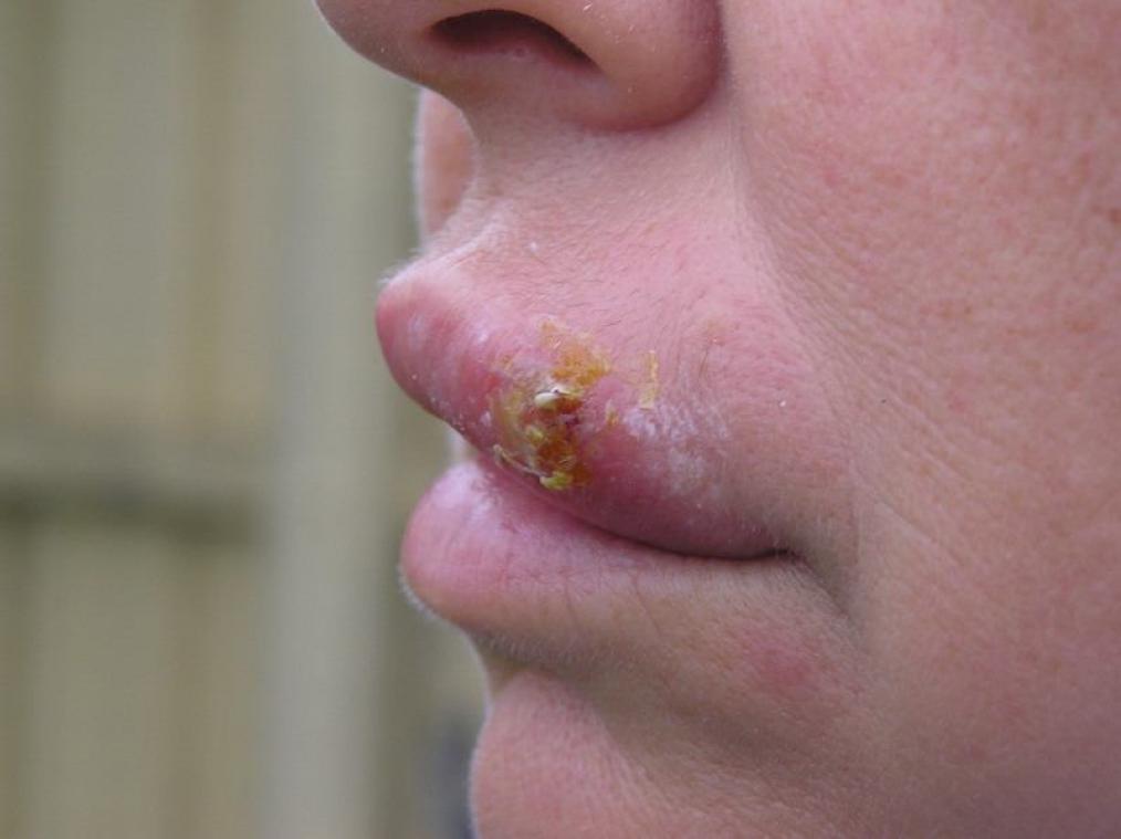 BIZAR. Man eist 150.000 euro schadevergoeding van date nadat hij herpes opliep door kus
