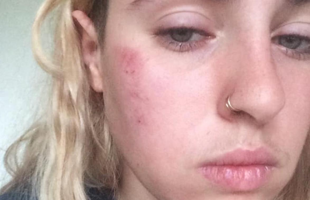 Brusselse vrouw in elkaar geslagen nadat ze vriendin kust: "Ze noemden me een vuile lesbienne"