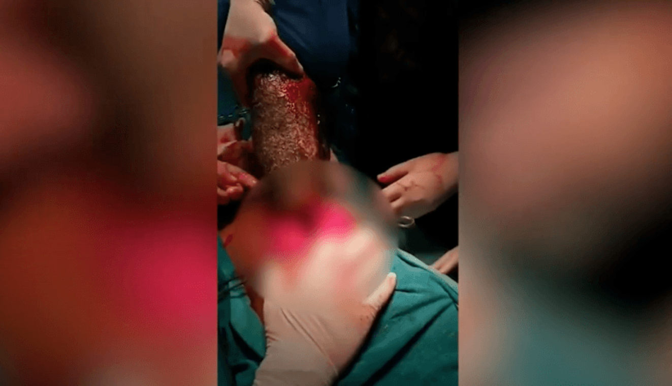 BIZAR. Haarbal van zeven kilo verwijderd uit maag van Indiaas tienermeisje (video)