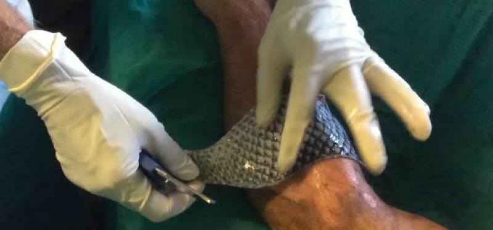 Deze bizarre methode moet brandwonden genezen