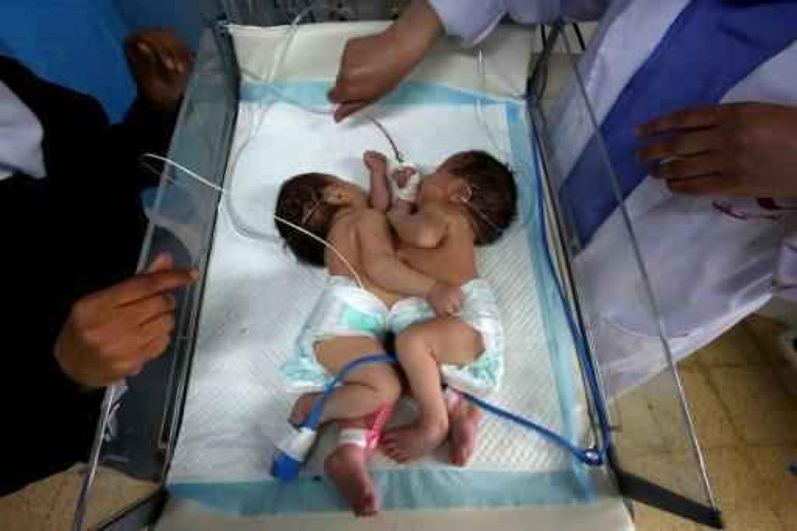 Palestijnse vrouw zet Siamese tweeling op de wereld