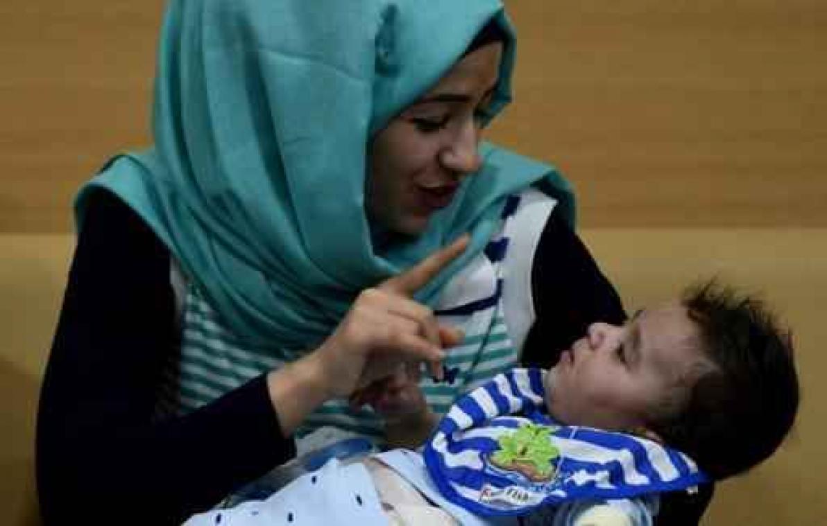 Baby met acht armen en benen succesvol geopereerd in India