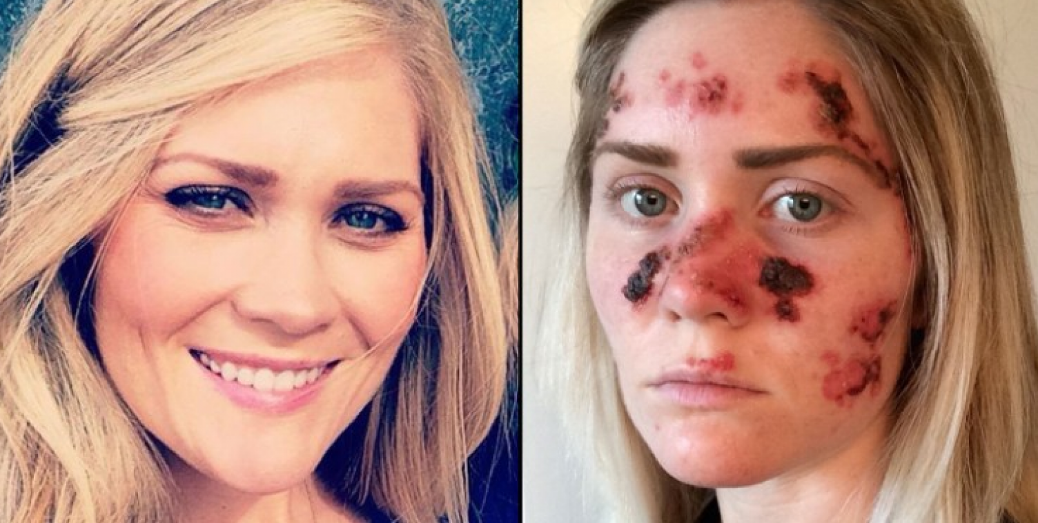 Slachtoffer huidkanker post choquerende selfie als waarschuwing
