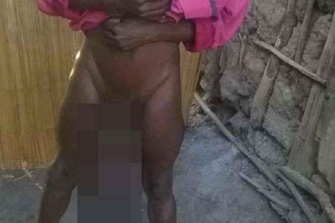 Man met grootste penis ter wereld ondergaat operatie