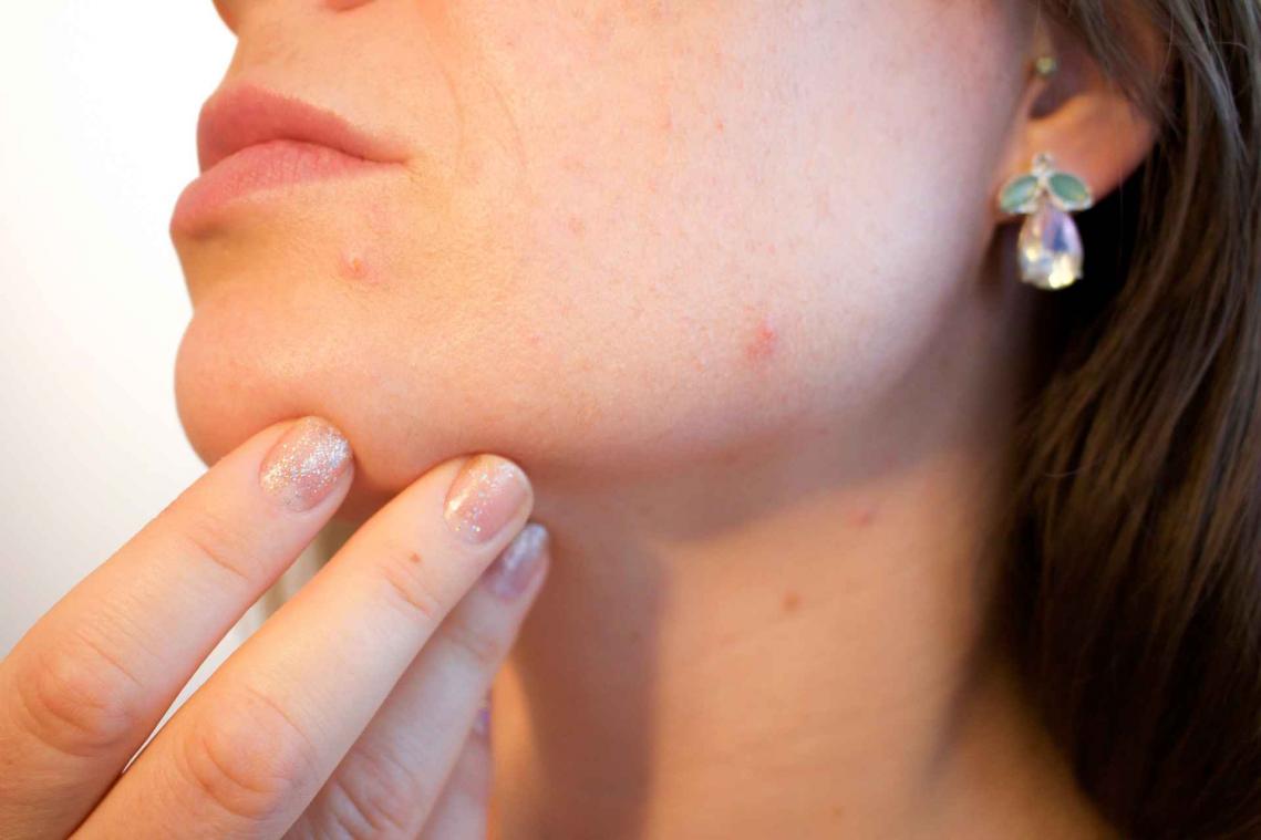 Last van puistjes? Dan loop je meer kans op een depressie