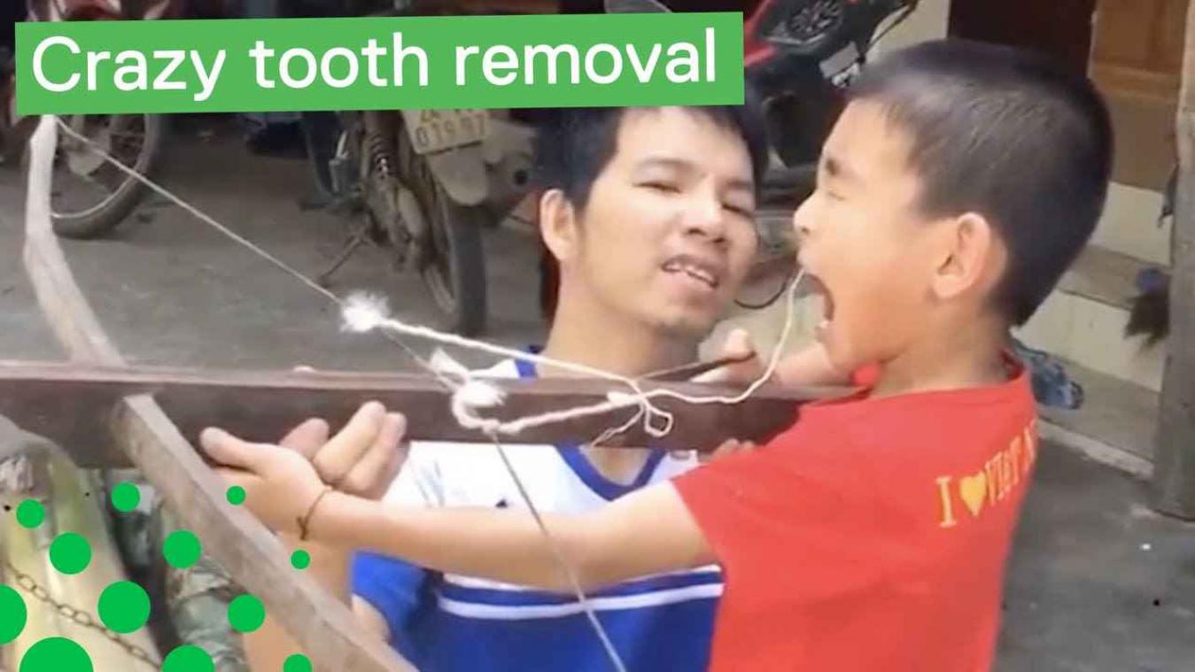 VIDEO. Jongetje laat tand uittrekken met kruisboog