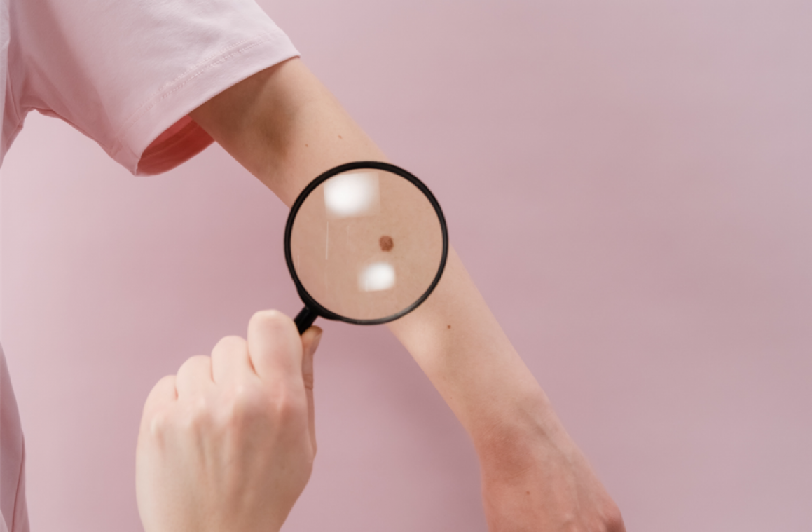 Dit bekende geneesmiddel kan mogelijk ook huidkanker genezen: «Maar experimenteer niet zelf»