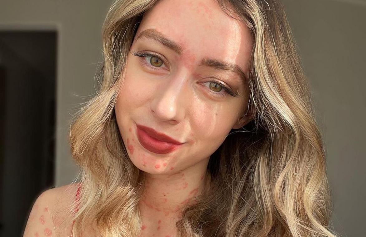 Vrouw toont huidziekte in eerlijke lingeriefoto’s: «Je bent een ware inspiratie»