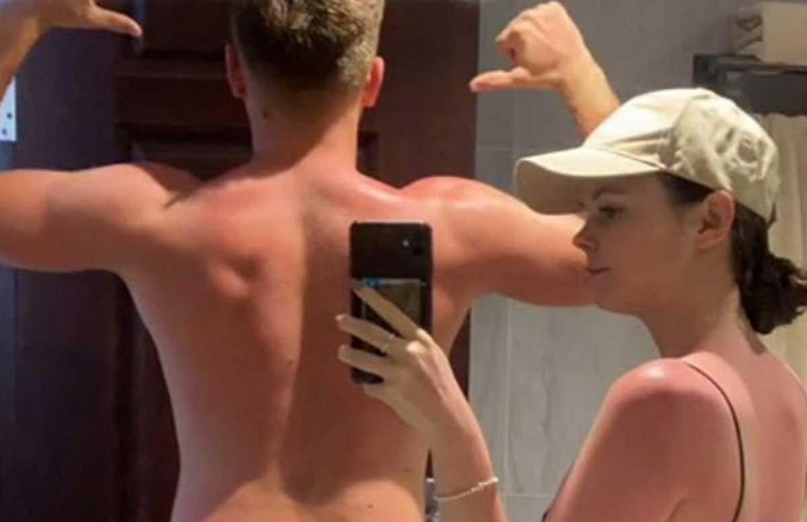 Koppel toont wat ‘valse’ zonnecrème met hun lichaam deed: «Zo erg voor jullie!»