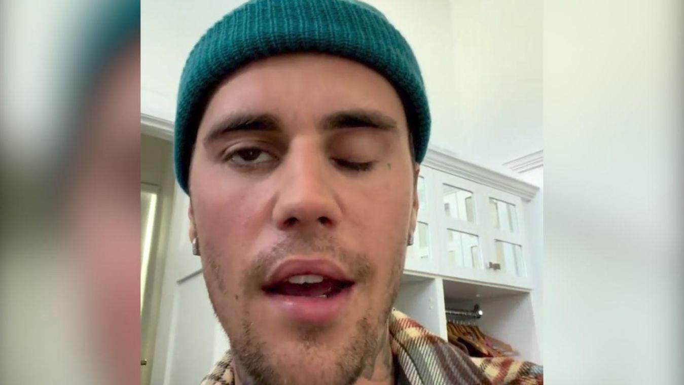 Gezicht van Justin Bieber deels verlamd door zeldzame ziekte