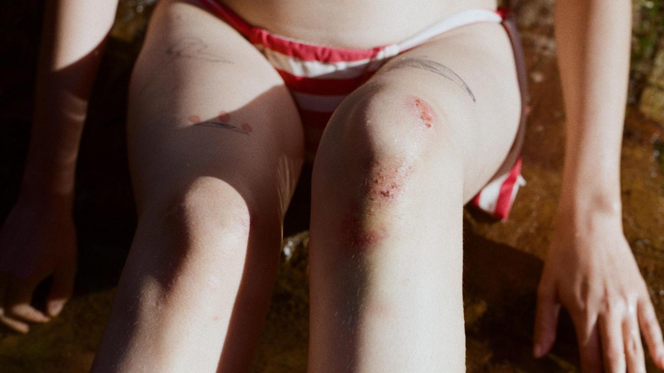 Aha! Daarom heb je ‘zomaar’ blauwe plekken