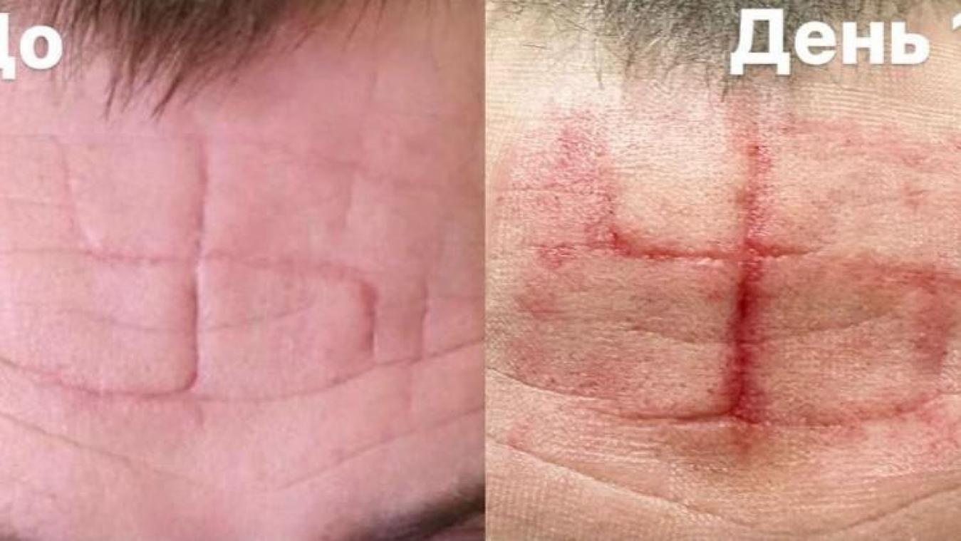 Oekraïense soldaat «kreeg hakenkruis in voorhoofd gegraveerd» door Russen