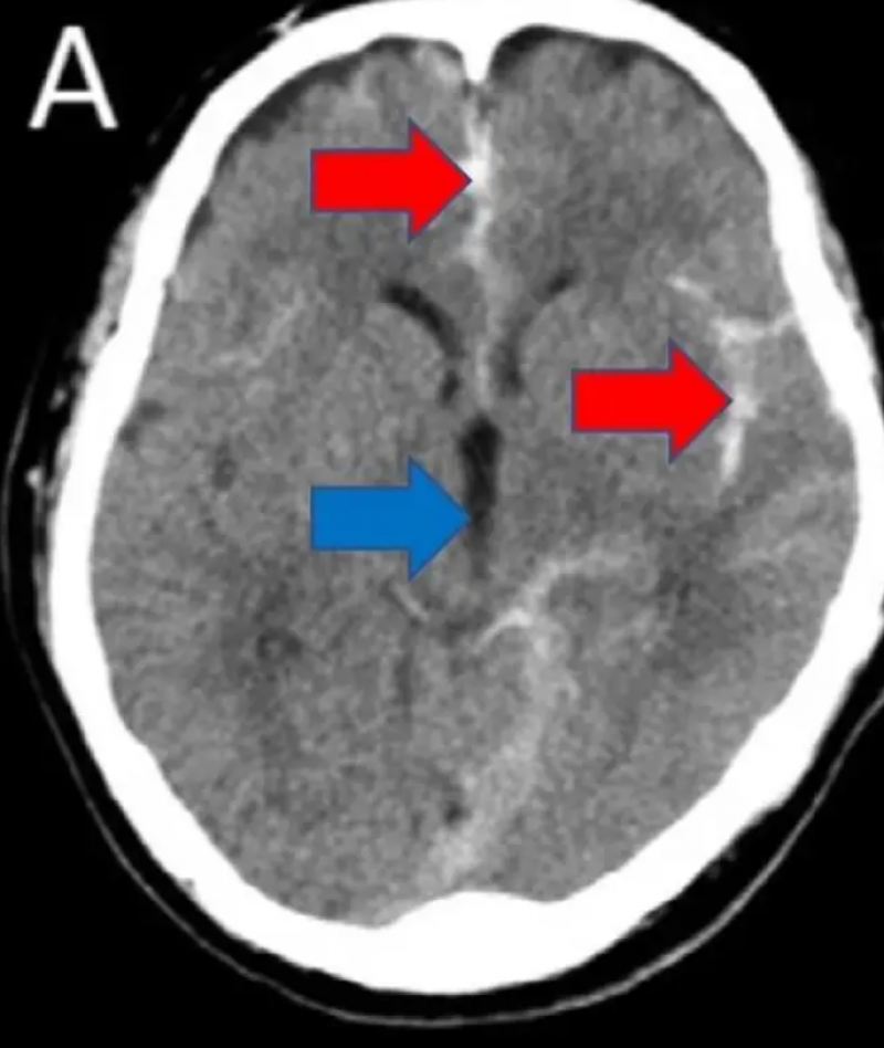 De blauwe pijl wijst naar hoe een normale hersenholte er moet uitzien, gevuld met hersenvocht. De rode pijlen wijzen naar hersenholtes die gevuld zijn met bloed.